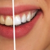 Ways to Get a Perfect Smile