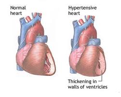 normal heart & hypertensive heart