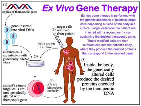 Ex Vivo Gene Therapy