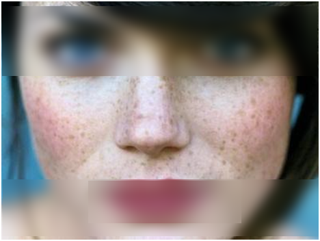 Freckles home remedies