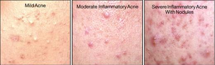 mild acne vulgaris