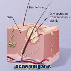 acne vulgaris or pimple