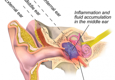 Sticky Otitis Media: Understanding and Treating Glue Ear