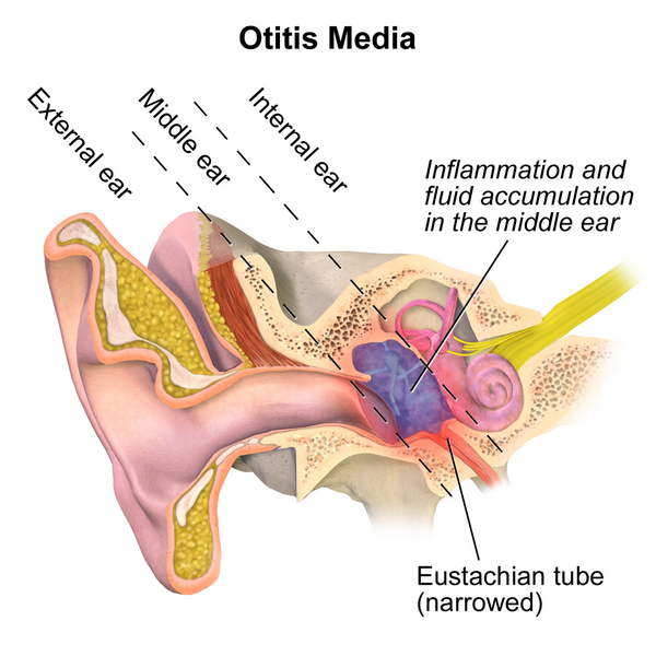 Otitis_Media_glue_ear