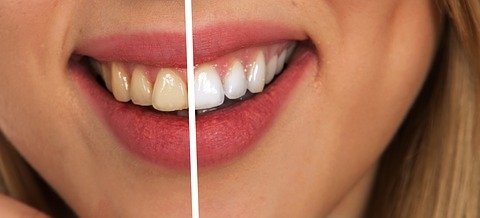 Make Your Teeth White and Beautiful