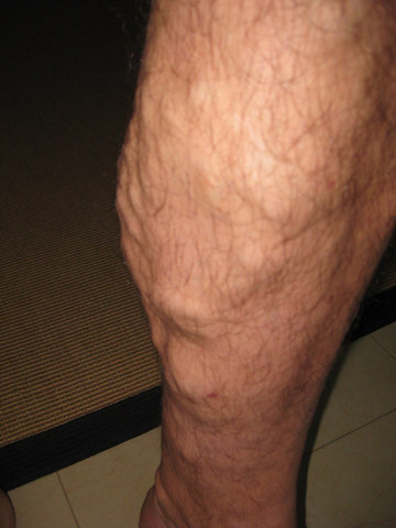 Varicose veins