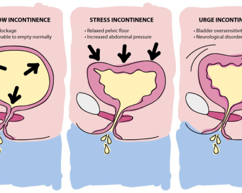 Cause for Urge Incontinence