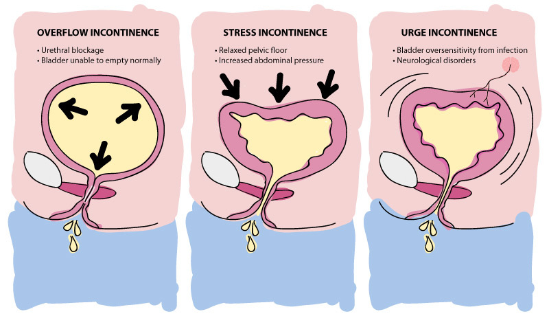 Cause for Urge Incontinence