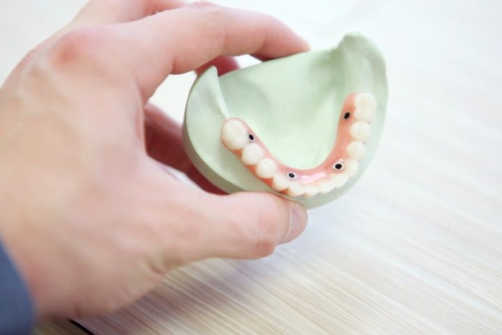 What to Consider When Considering Dental Veneers