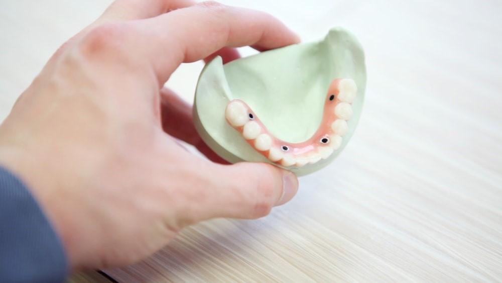What to Consider When Considering Dental Veneers